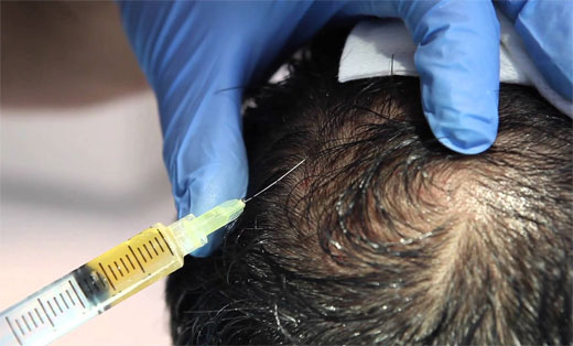 Alopecia PRP