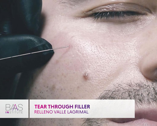 BAAS: Relleno de valle lagrimal / Tear through filler