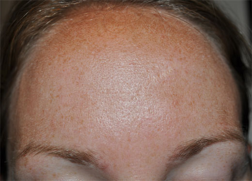 MELASMA