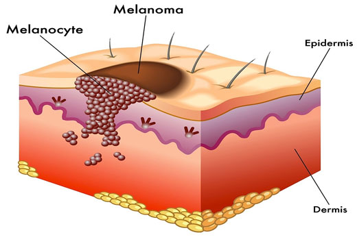 MELANOMA