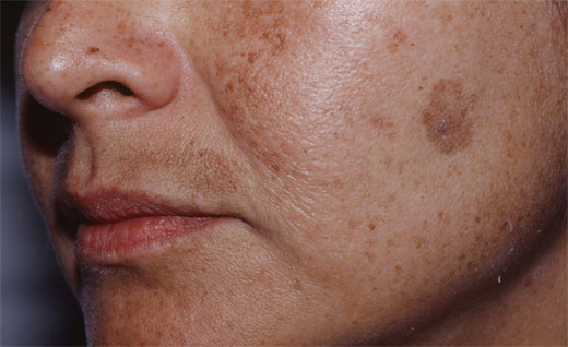 MELASMA