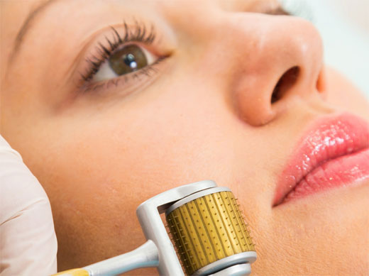 Microneedling