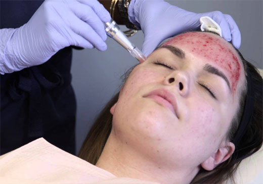 microneedling