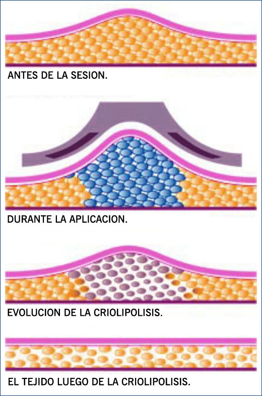 CRIOLIPOLISIS