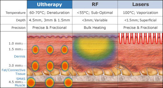 Ultherapy