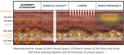 Ultherapy