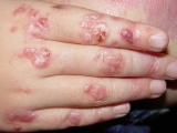 Epidermlisis bullosa (EB)