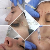 Agosto: curso presencial de Armonizacin Panfacial